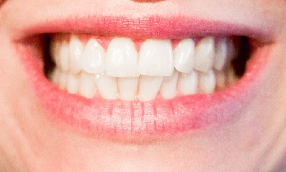 So einfach können Sie Hohlräume zwischen den Zähnen vermeiden