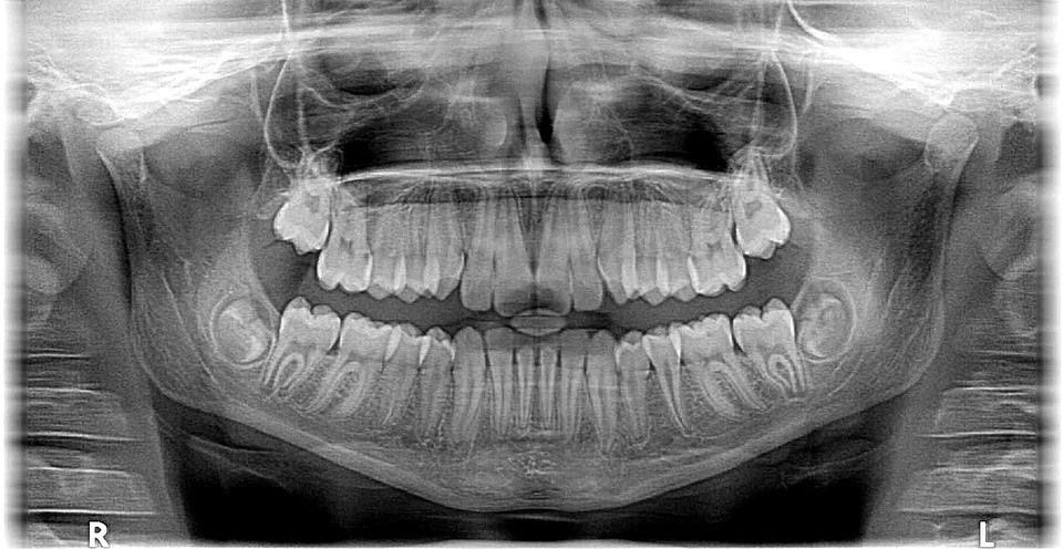 Grundbegriffe der zahnärztlichen Radiographie