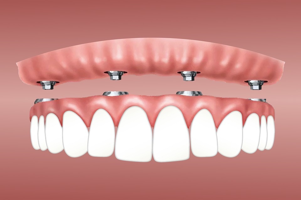 Die vier Arten von Zahnimplantaten