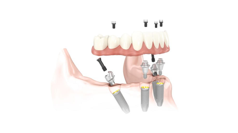 Brauche ich mit All-on-4 Implantaten noch Prothesenklebstoffe?