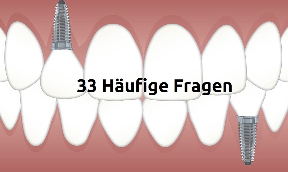 Zahnersatz – 33 Häufige Fragen – FAQ
