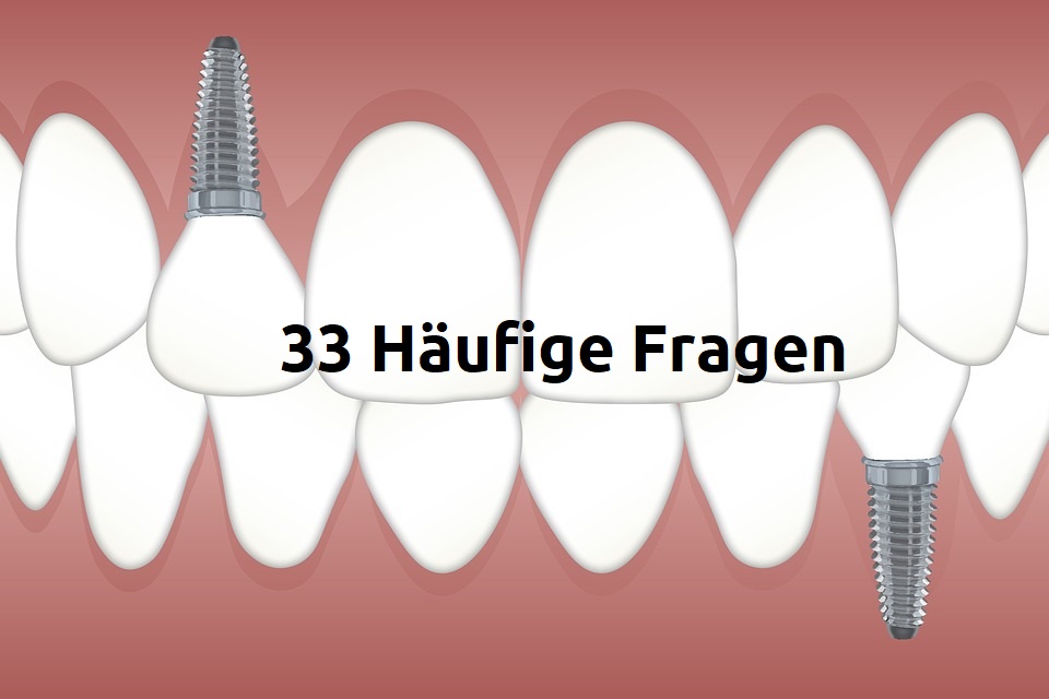 Zahnersatz – 33 Häufige Fragen – FAQ