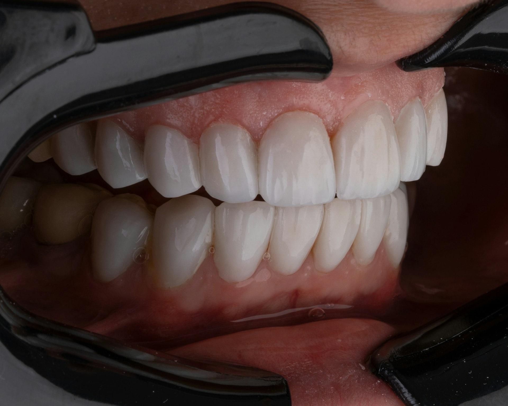 5 empfehlenswerte Zahnarztpraxen für Veneers in Deutschland